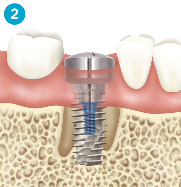 Implant Step Two